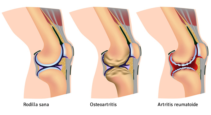 Artrosis en la rodilla sintomas