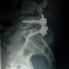 Un estudio confirma el uso de la artrodesis vertebral en casos de espondilolistesis y fracturas vertebrales